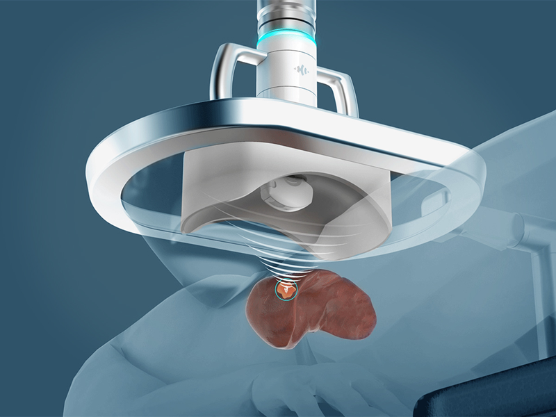 Histotripsy therapy platform targeted for liver tumours